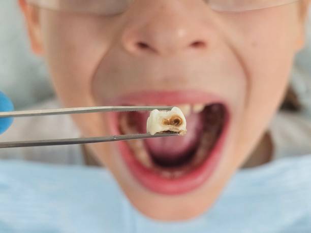 Best Emergency Dental Care for Broken or Chipped Teeth in Brewster Heights, NY